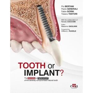 TOOTH OR IMPLANT?
